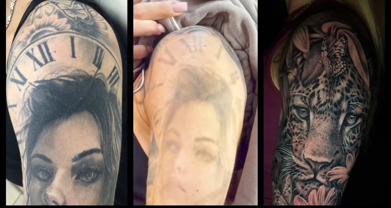 Arm sleeve removal before and after laser tattoo removal