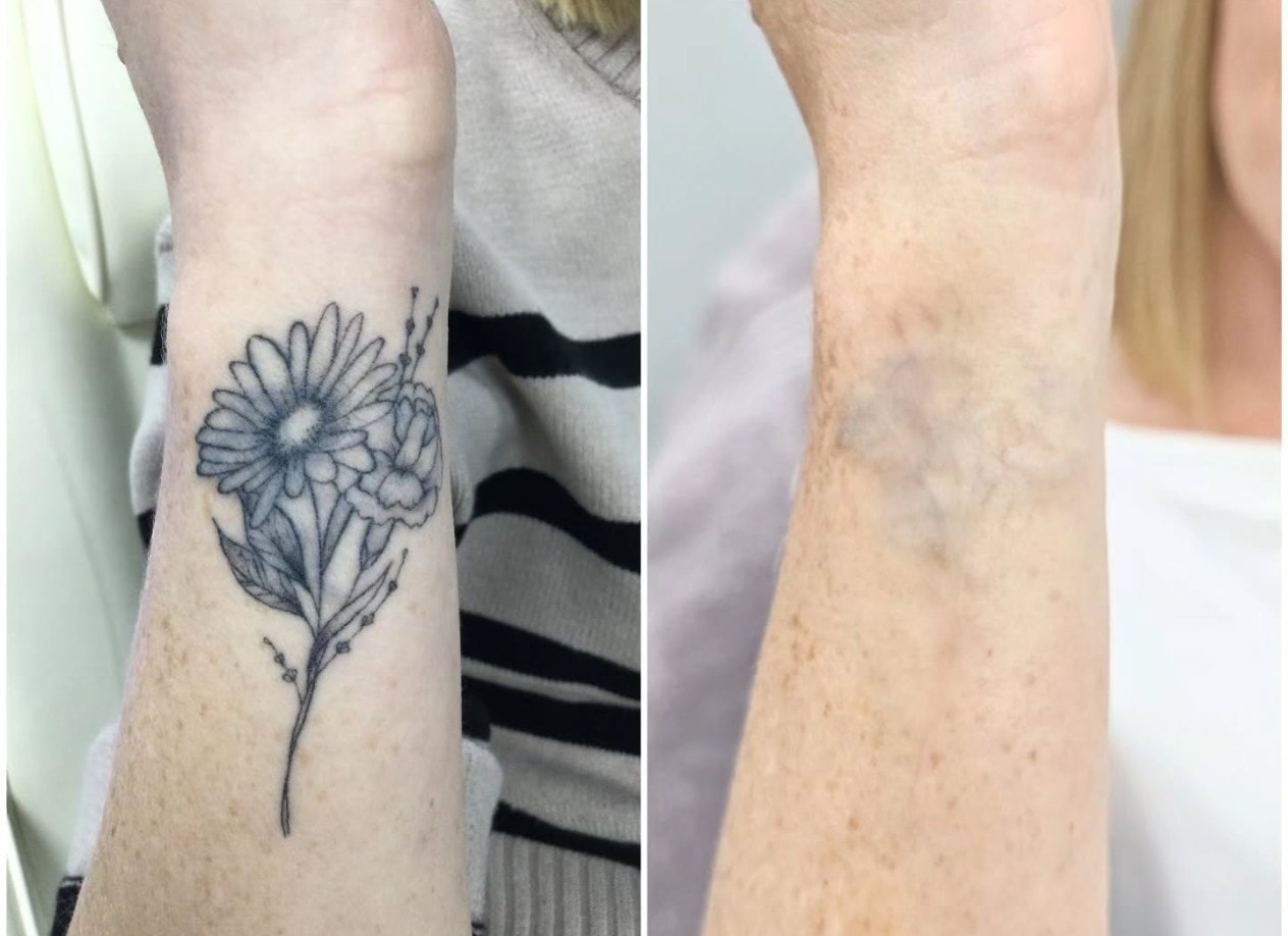 Wrist daisy tattoo before and after laser tattoo removal