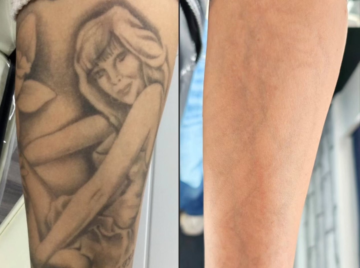 Full arm clearance before and after laser tattoo removal