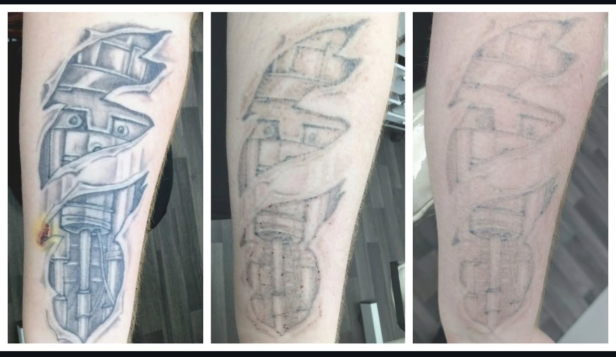 Forearm tattoo before and after laser tattoo removal