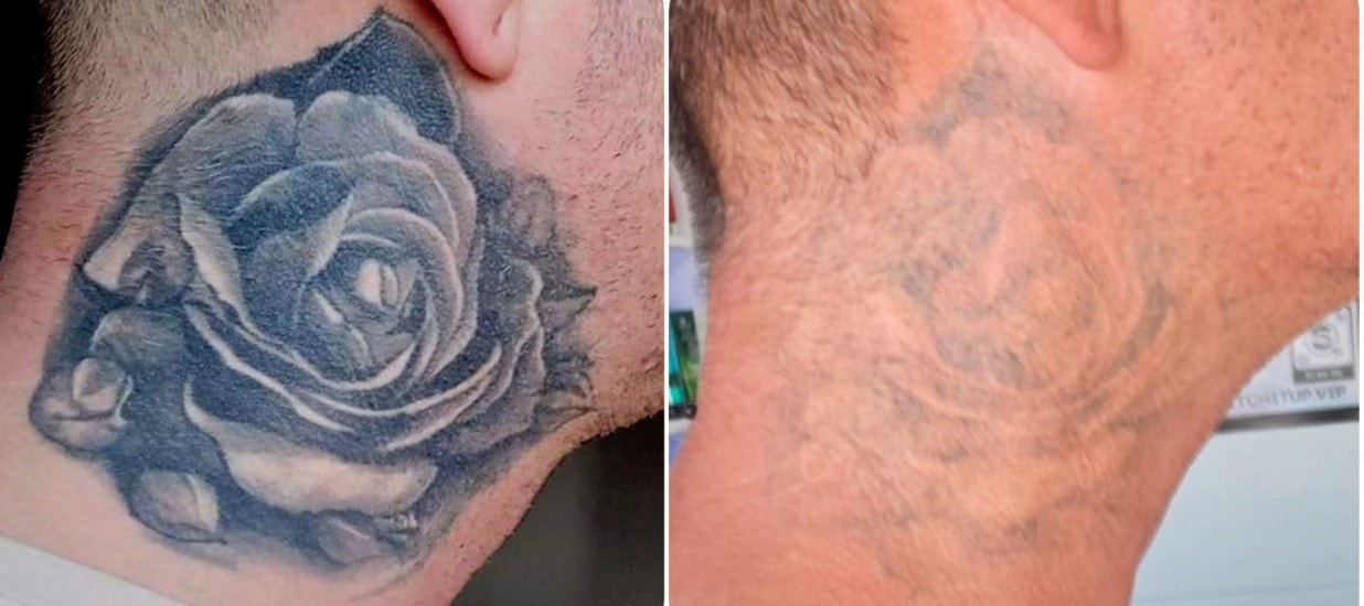 Neck rose tattoo before and after laser tattoo removal